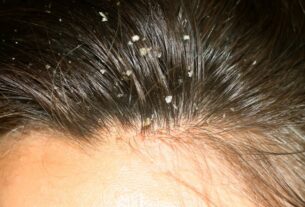 Πιτυρίδα θεραπεία