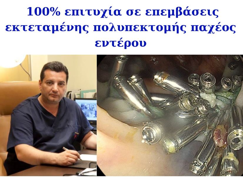 Πειραιάς: 100% επιτυχία σε επεμβάσεις εκτεταμένης πολυπεκτομής παχέος εντέρου από τον Dr Σταύρο Καρακατσάνη