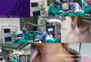 Πρωτοποριακή διπλή επέμβαση: Ολική θυρεοειδεκτομή και face lift ταυτόχρονα!