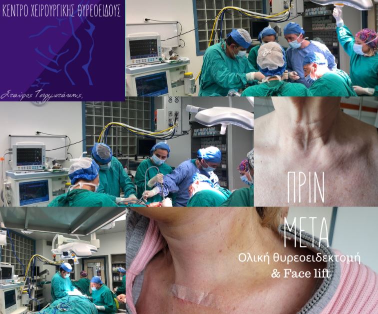 Πρωτοποριακή διπλή επέμβαση: Ολική θυρεοειδεκτομή και face lift ταυτόχρονα!