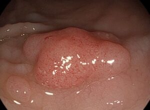 Κακοήθεια ορθού