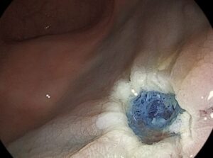 Κακοήθεια ορθού