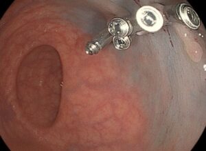 Κακοήθεια ορθού