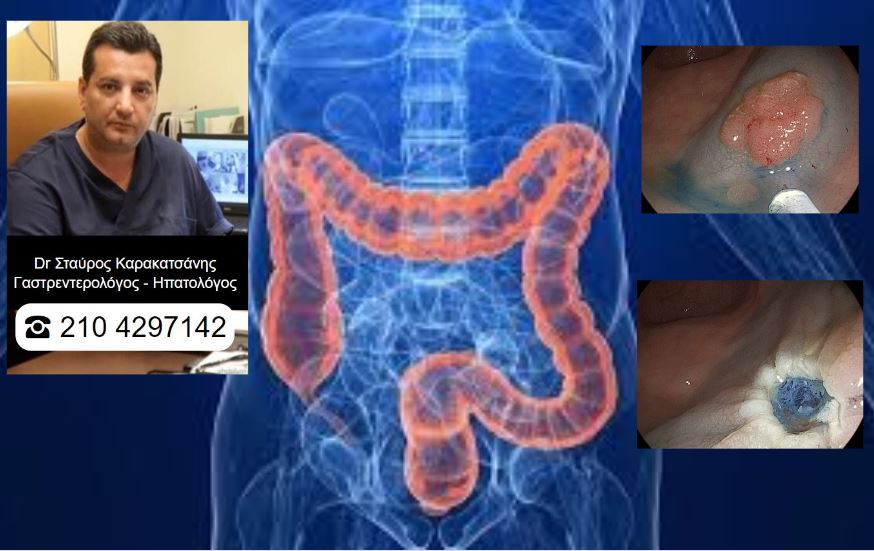 Κολονοσκόπηση και επιτυχής αφαίρεση Καρκίνου του εντέρου στην Ενδοσκοπική Μονάδα Πειραιά!!