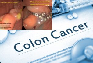 Πειραιάς: Πολυποδεκτομή υψηλού βαθμού δυσκολίας σε εξέταση κολονοσκόπησης από τον Δρ. Σταύρο Καρακατσάνη