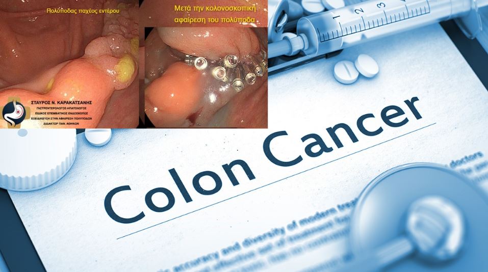 Πειραιάς: Πολυποδεκτομή υψηλού βαθμού δυσκολίας σε εξέταση κολονοσκόπησης από τον Δρ. Σταύρο Καρακατσάνη
