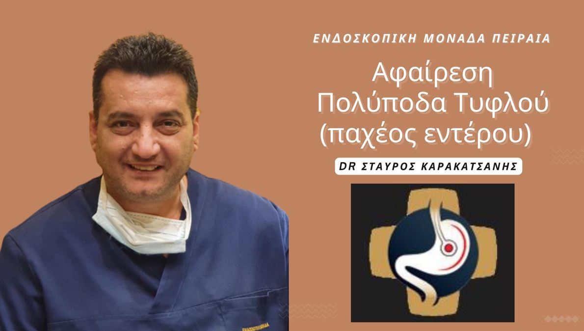 Πρωτοποριακή επέμβαση Αφαίρεσης Πολύποδα Τυφλού (παχέος εντέρου) στην Ενδοσκοπική Μονάδα Πειραιά!