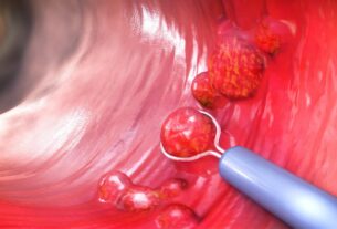 Πολύποδες παχέος εντέρου: Αφαίρεση πολύποδα στο Ανιόν